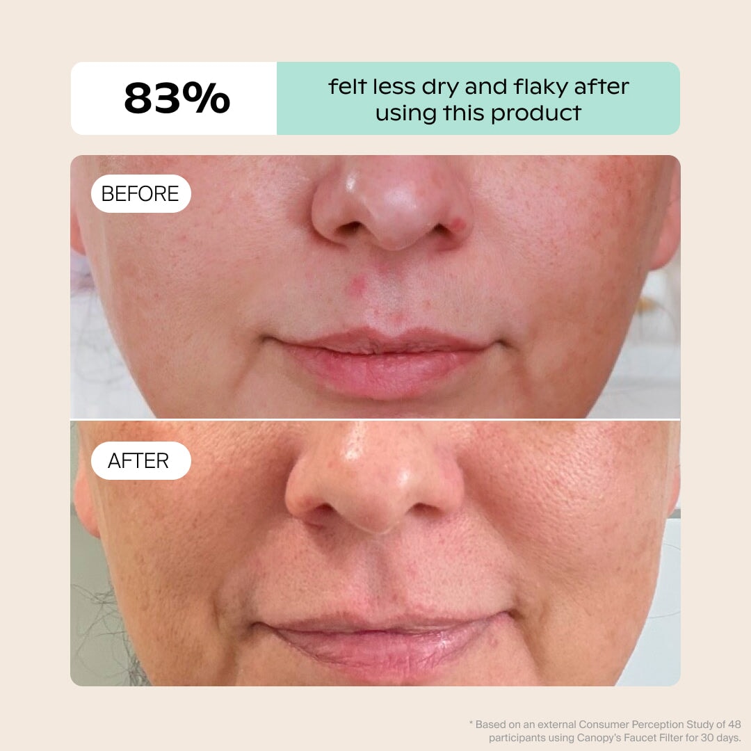 Close-up of a person’s lower face before and after using Canopy’s Faucet Filter. The “before” shows dry, red, flaky skin; “after” shows healthier skin. Fulfilled by Canopy. 83% felt less dry and flaky after use.