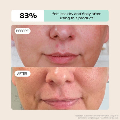 Close-up of a person’s lower face before and after using Canopy’s Faucet Filter. The “before” shows dry, red, flaky skin; “after” shows healthier skin. Fulfilled by Canopy. 83% felt less dry and flaky after use.