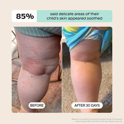 White Lavender Jade Butter Seafoam Oat
Close-up of a child’s leg: red, irritated skin “Before” and smoother “After 30 Days” using the Canopy Baby Bath Tub Filter. Text above reads: 85% saw soothed skin after 30 days. Fulfilled by Canopy.