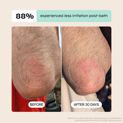 Side-by-side close-ups of an elbow with dry, irritated skin: "BEFORE" shows more redness; "AFTER 30 DAYS" shows improvement. Text states 88% saw less irritation post-bath using Canopy Bath Tub Filter.